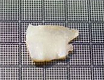 비중격연골